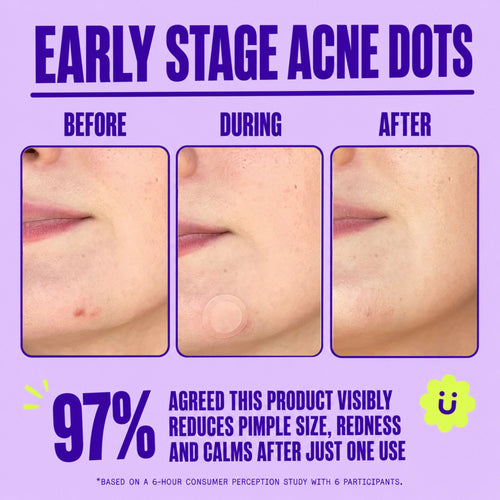 Microneedle Patches