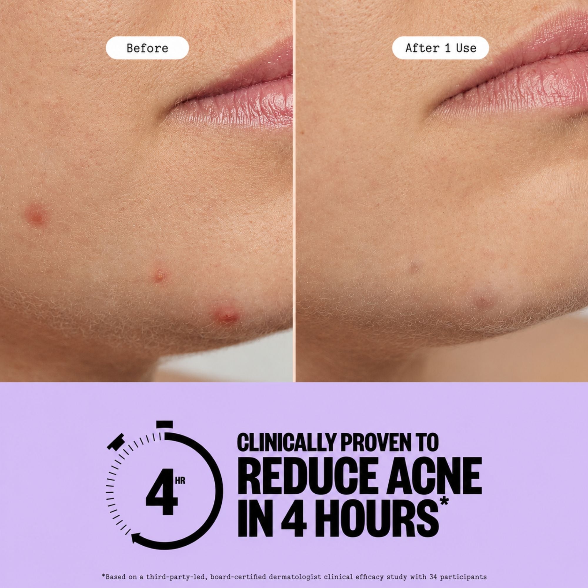 Hydrocolloid Star Patches